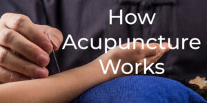 Practitioner inserting acupuncture needle into arm